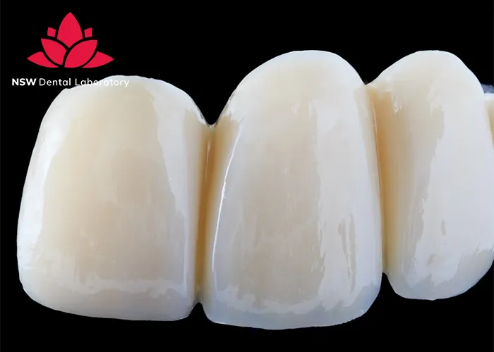 Anterior-Bridge-An-Excellent-Solution-for-Functional-and-Aesthetic-Restoration