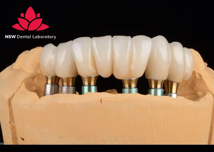 Anterior-Bridge-An-Excellent-Solution-for-Functional-and-Aesthetic-Restoration