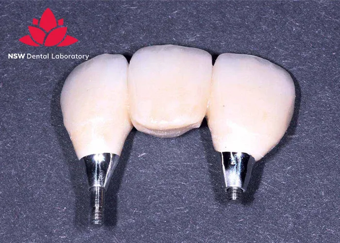 Anterior-Bridge-An-Excellent-Solution-for-Functional-and-Aesthetic-Restoration