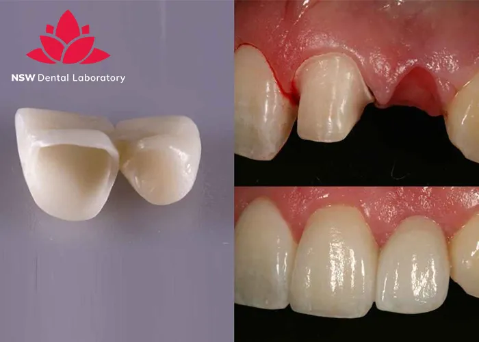 Anterior-Bridge-An-Excellent-Solution-for-Functional-and-Aesthetic-Restoration