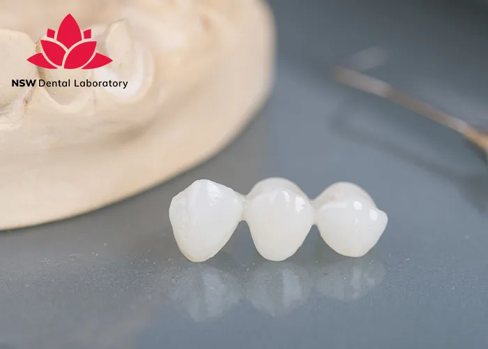 Dental-Bridge-And-Implant-Which-Is-The-Best-Choice-For-You