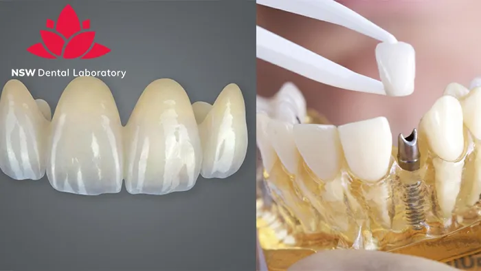 Dental Bridge And Implant: Which Is The Best Choice For You?