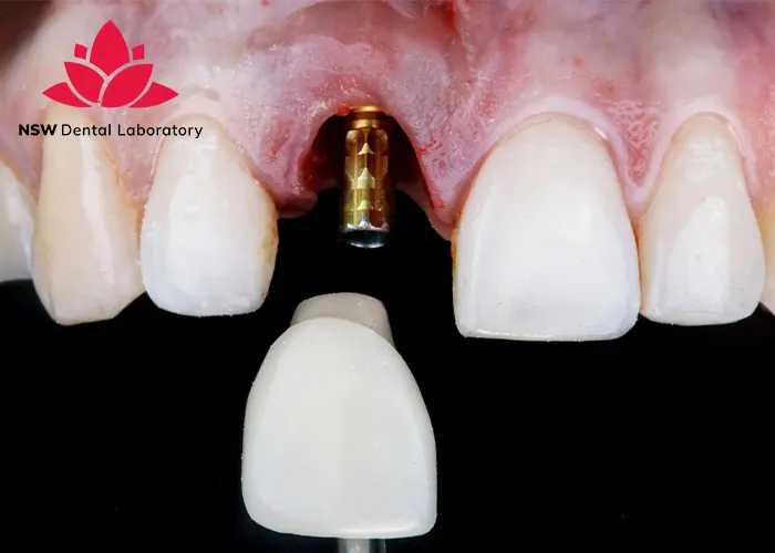 Dental-Bridge-And-Implant-Which-Is-The-Best-Choice-For-You