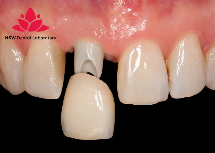 Dental-Bridge-And-Implant-Which-Is-The-Best-Choice-For-You