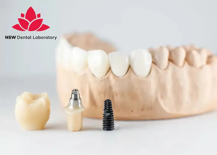 Dental-Bridge-And-Implant-Which-Is-The-Best-Choice-For-You