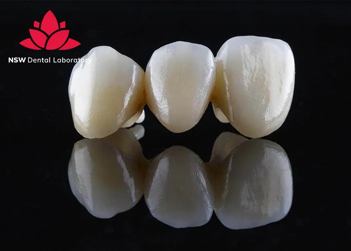 Dental-Bridge-And-Implant-Which-Is-The-Best-Choice-For-You