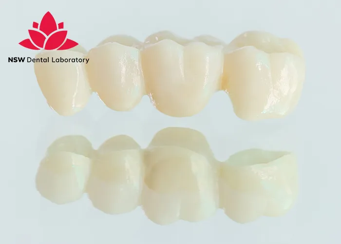 Dental-Bridge-And-Implant-Which-Is-The-Best-Choice-For-You