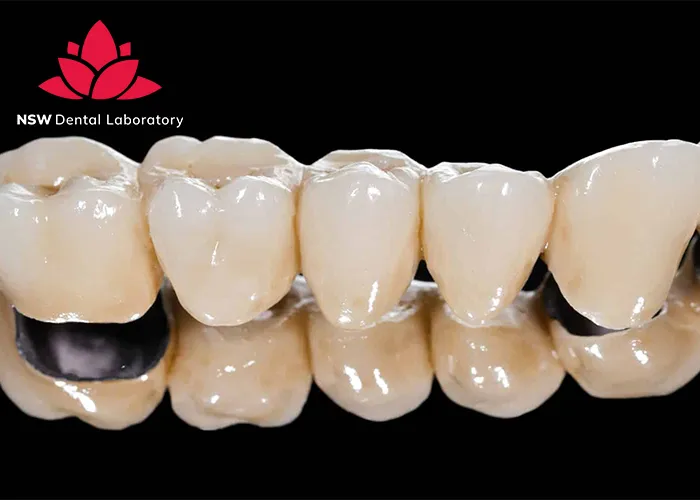 Dental-Bridge-And-Implant-Which-Is-The-Best-Choice-For-You