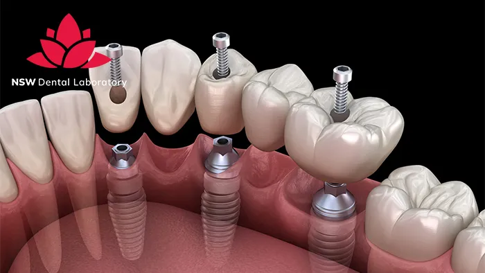 Dental Implant Bridges: The Ultimate Solution For Missing Teeth