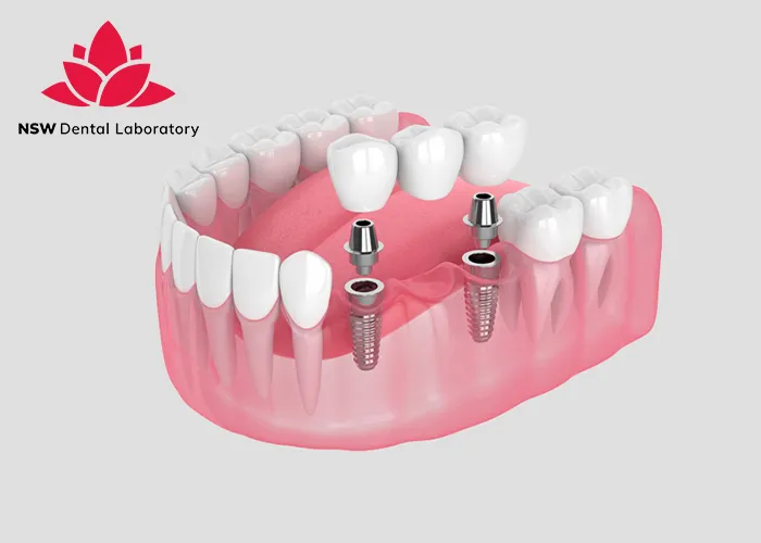 Dental-Implant-Bridges-The-Ultimate-Solution-For-Missing-Teeth
