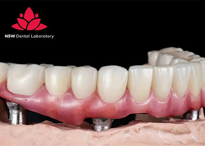 Dental-Implant-Bridges-The-Ultimate-Solution-For-Missing-Teeth