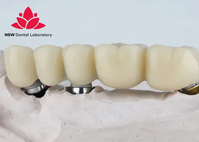 Dental-Implant-Bridges-The-Ultimate-Solution-For-Missing-Teeth
