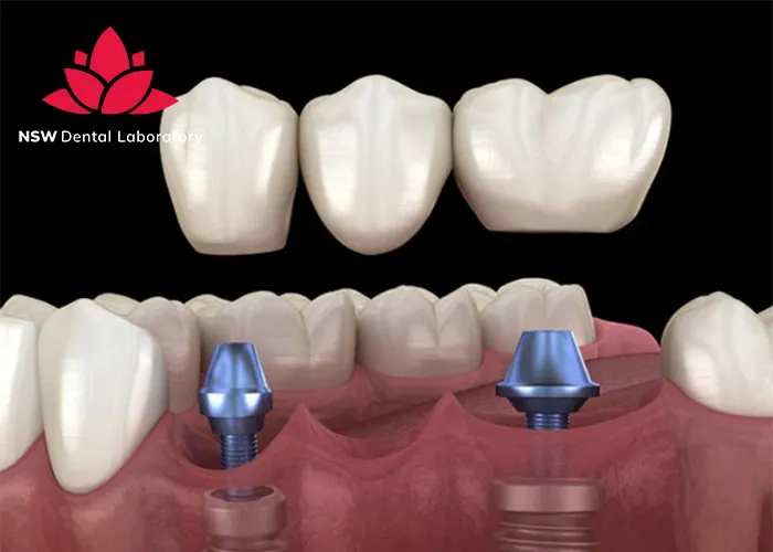 Dental-Implant-Bridges-The-Ultimate-Solution-For-Missing-Teeth