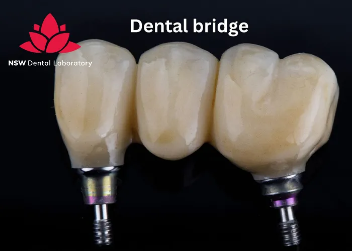 Dental-Implant-Bridges-The-Ultimate-Solution-For-Missing-Teeth