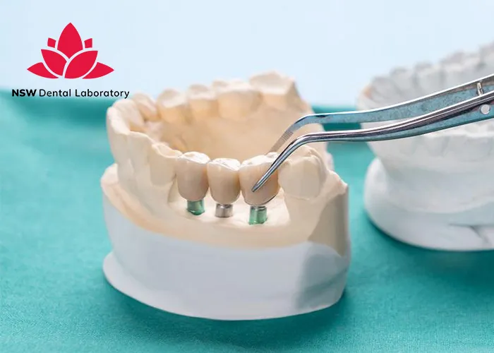 Dental-Implant-Bridges-The-Ultimate-Solution-For-Missing-Teeth