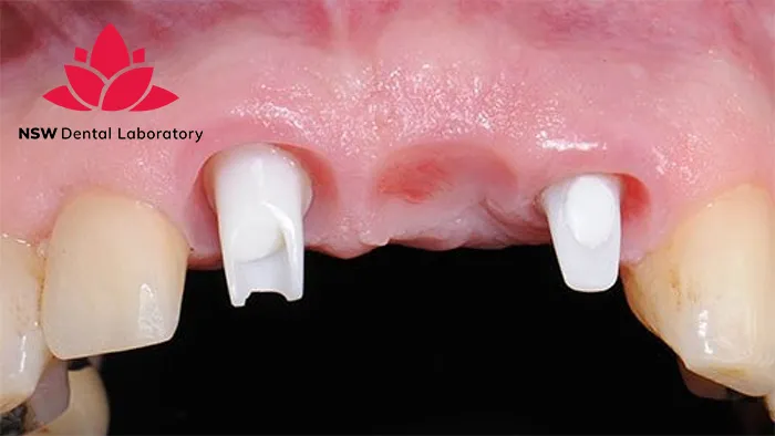 Implant Bridge For Front Teeth: Is This The Best Solution Right For You?
