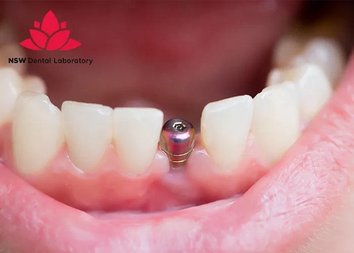 Implant-Bridge-For-Front-Teeth-Is-This-The-Best-Solution-Right-For-You?