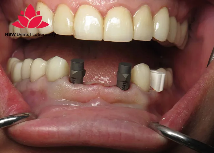 Implant-Bridge-For-Front-Teeth-Is-This-The-Best-Solution-Right-For-You?