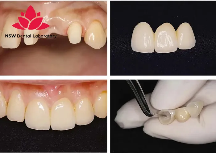 Implant-Bridge-For-Front-Teeth-Is-This-The-Best-Solution-Right-For-You?