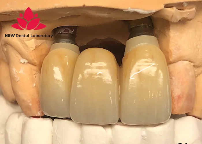 Implant-Bridge-For-Front-Teeth-Is-This-The-Best-Solution-Right-For-You?